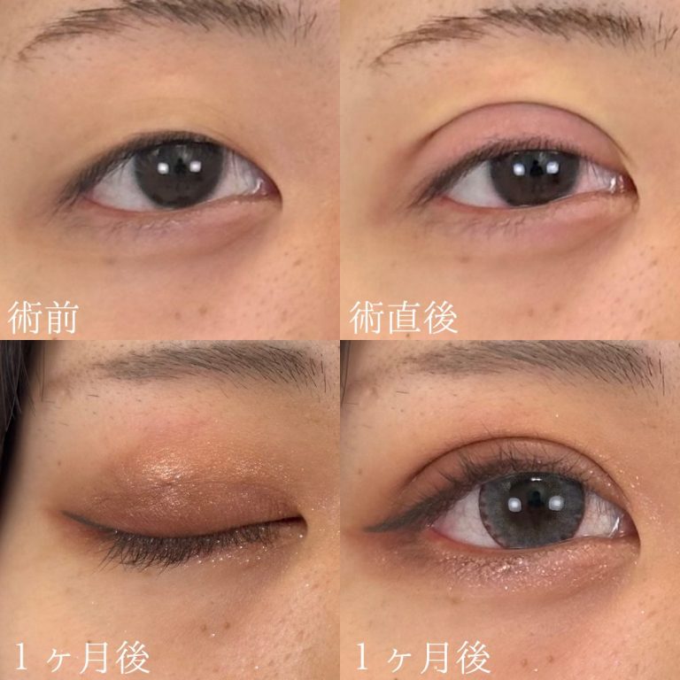 二重埋没法(担当医:TCB 医師)の症例写真1