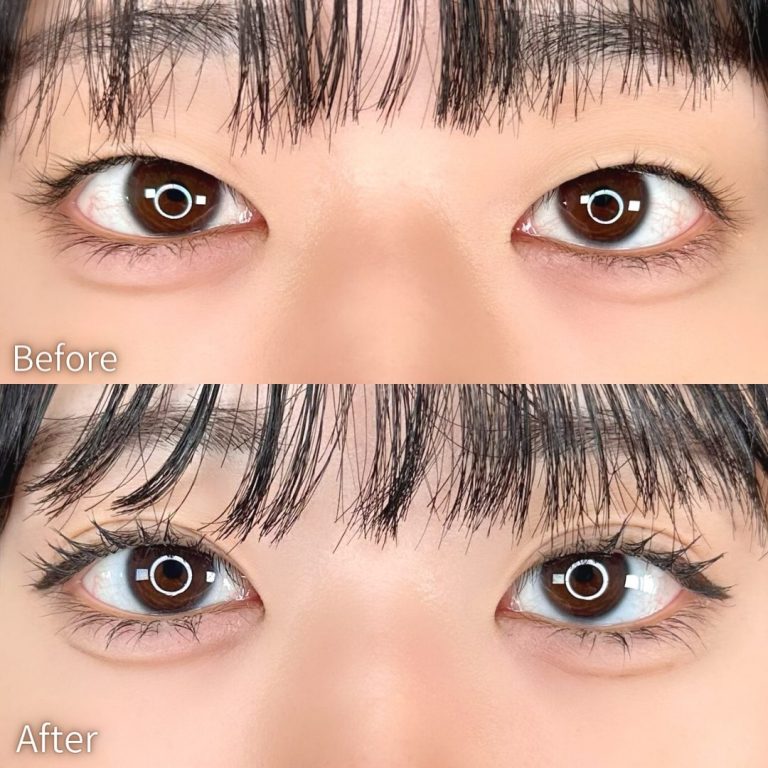 二重埋没法(担当医:TCB 医師)の症例写真1
