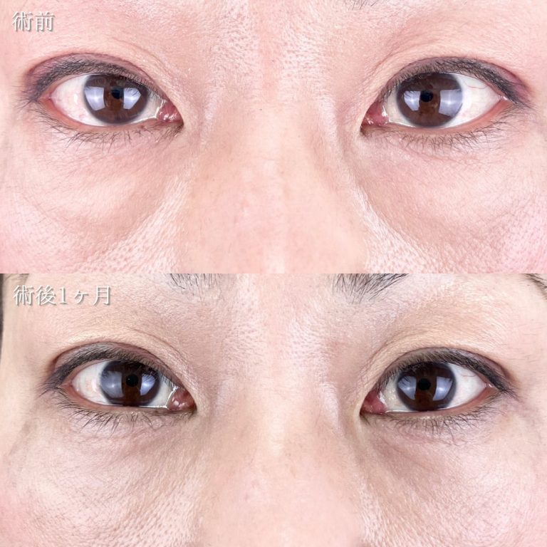 切らない目の下のクマ取り・目の下のたるみ（ふくらみ）取り(担当医:TCB 医師)の症例写真1