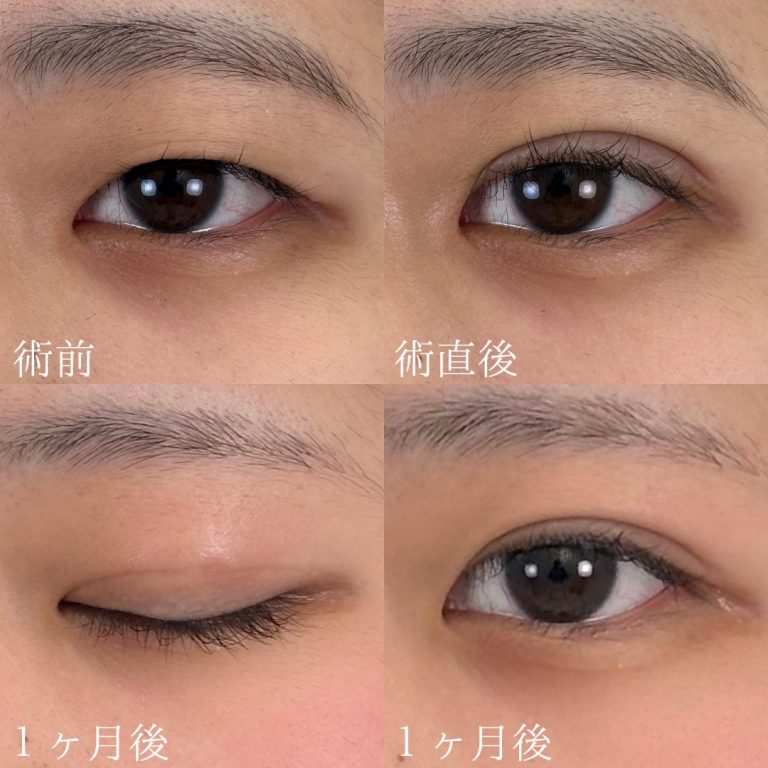 二重埋没法(担当医:TCB 医師)の症例写真1