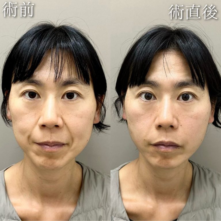 TCB式小顔美肌再生(担当医:中村 杏奈 医師)の症例写真1