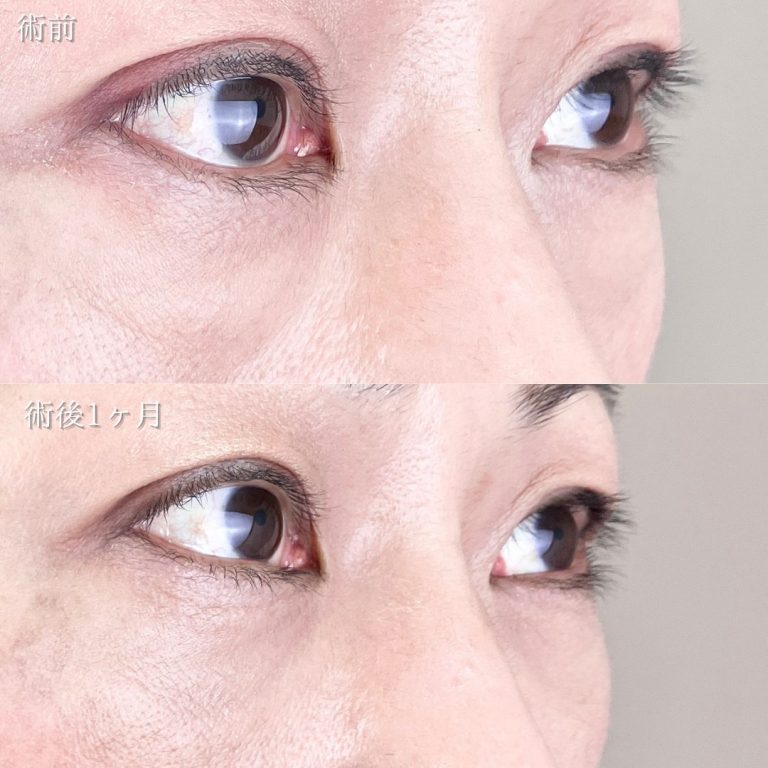 切らない目の下のクマ取り・目の下のたるみ（ふくらみ）取り(担当医:TCB 医師)の症例写真2