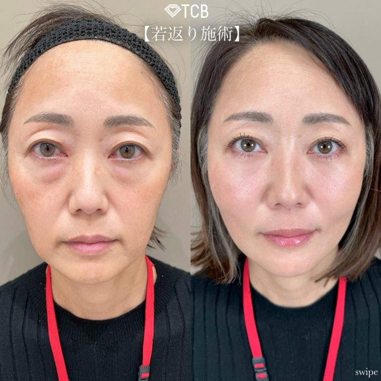 お顔の脂肪注入「ナノファット2.0」(担当医:寺西 宏王 医師)の症例写真1