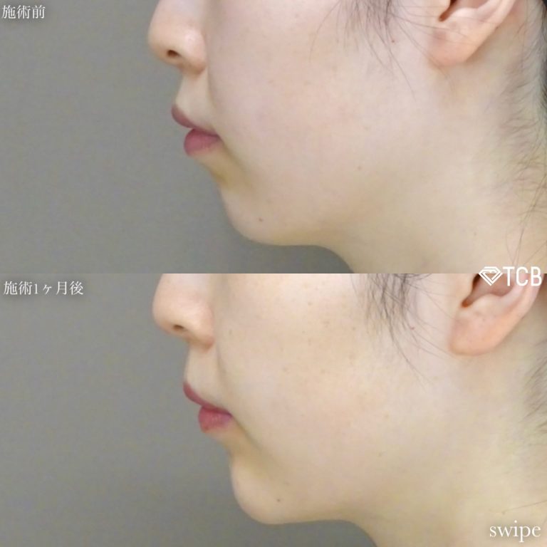 切らない顎形成 3D Eライン(担当医:寺西 宏王 医師)の症例写真1
