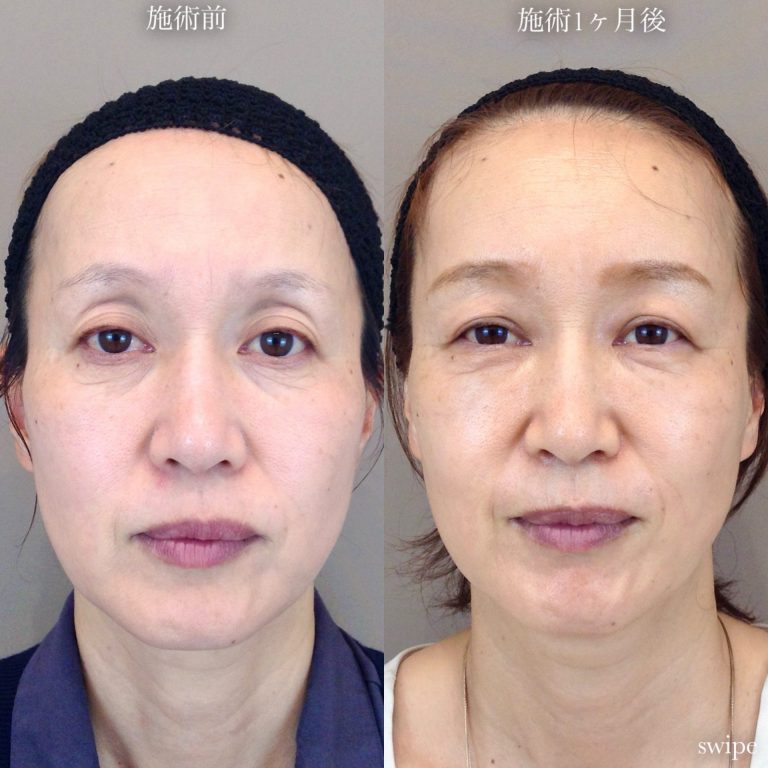お顔の脂肪注入「ナノファット2.0」(担当医:TCB 医師)の症例写真2
