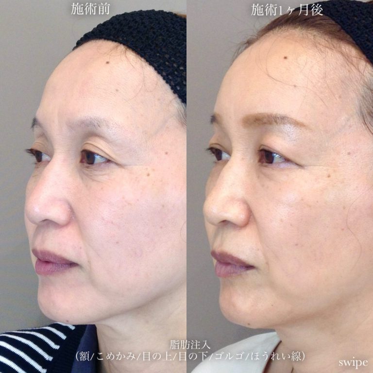 お顔の脂肪注入「ナノファット2.0」(担当医:TCB 医師)の症例写真1