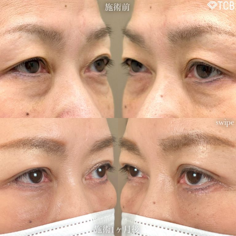 切開法による目の下のたるみ取り（下眼瞼除皺術）(担当医:寺西 宏王 医師)の症例写真1