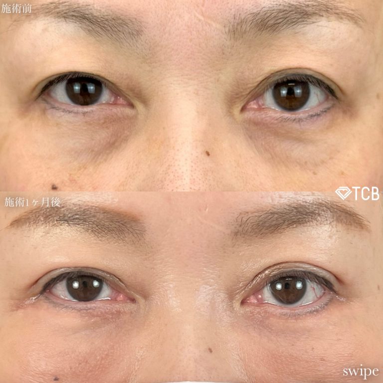 切開法による目の下のたるみ取り（下眼瞼除皺術）(担当医:寺西 宏王 医師)の症例写真2