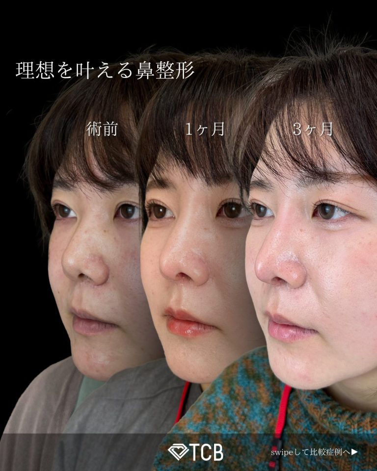 鼻中隔延長術(担当医:寺西 宏王 医師)の症例写真1