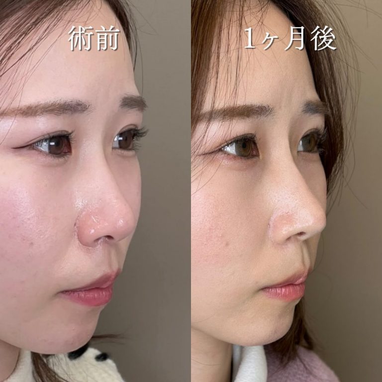 TCB式鼻先尖鋭術（だんご鼻解消）(担当医:中尾 聡一郎 医師)の症例写真1