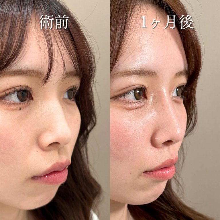 鼻プロテーゼ（隆鼻術）(担当医:中尾 聡一郎 医師)の症例写真1