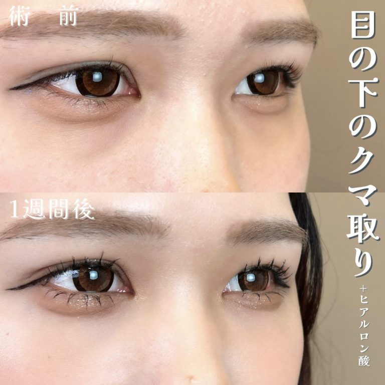 切らない目の下のクマ取り・目の下のたるみ（ふくらみ）取り(担当医:TCB 医師)の症例写真1