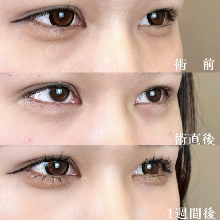 切らない目の下のクマ取り・目の下のたるみ（ふくらみ）取り(担当医:TCB 医師)の症例写真2
