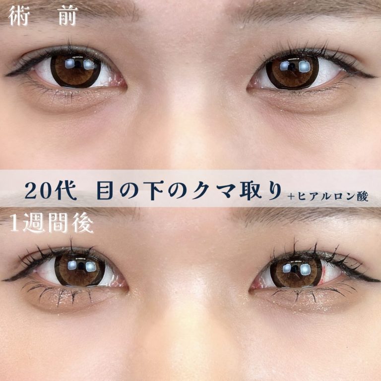 切らない目の下のクマ取り・目の下のたるみ（ふくらみ）取り(担当医:TCB 医師)の症例写真1