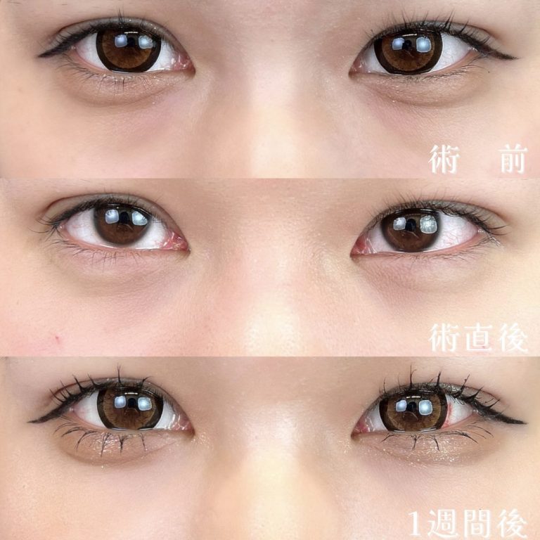 切らない目の下のクマ取り・目の下のたるみ（ふくらみ）取り(担当医:TCB 医師)の症例写真2