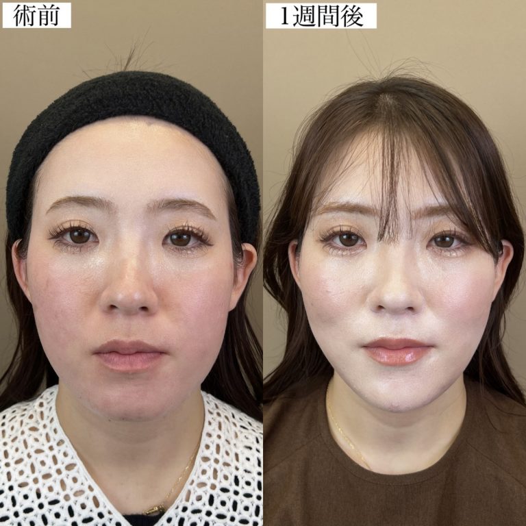 小顔美肌再生（リフトアップ）(担当医:TCB 医師)の症例写真2