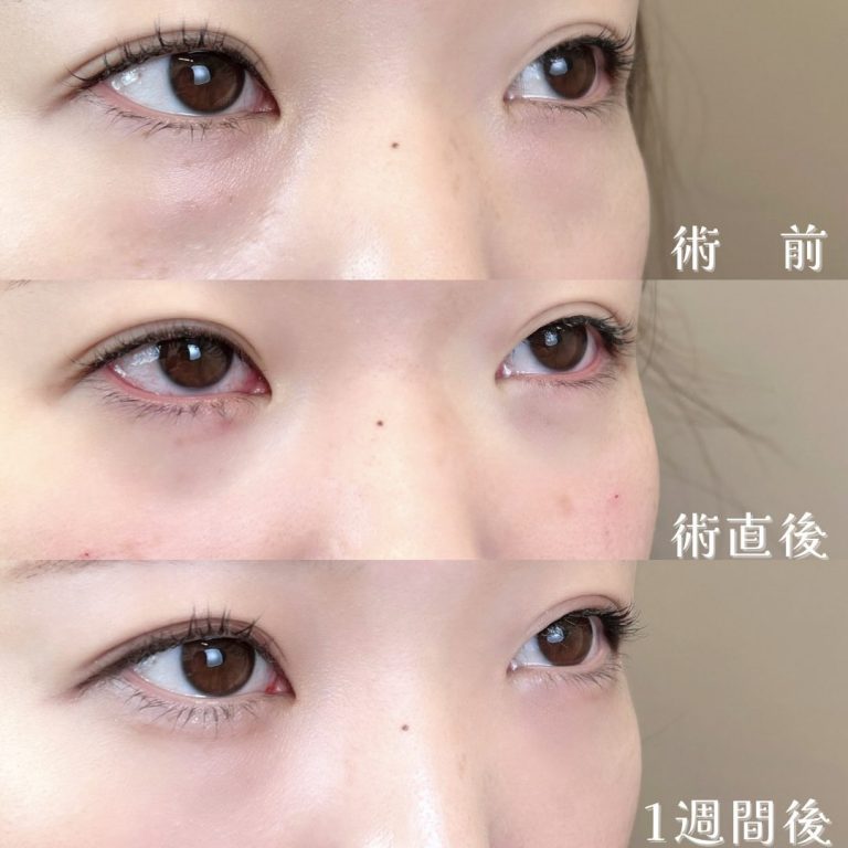 切らない目の下のクマ取り・目の下のたるみ（ふくらみ）取り(担当医:TCB 医師)の症例写真2