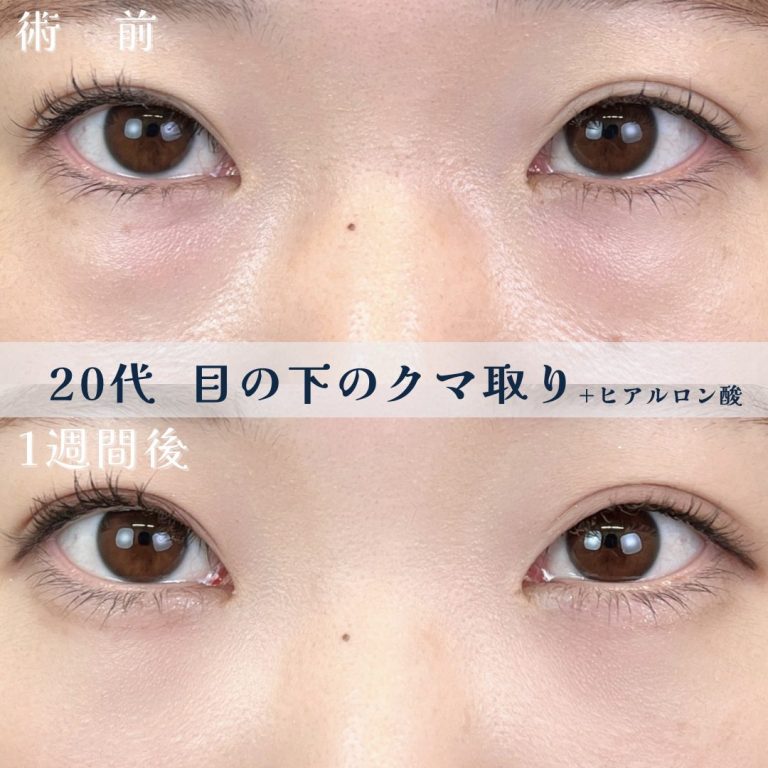 切らない目の下のクマ取り・目の下のたるみ（ふくらみ）取り(担当医:TCB 医師)の症例写真1