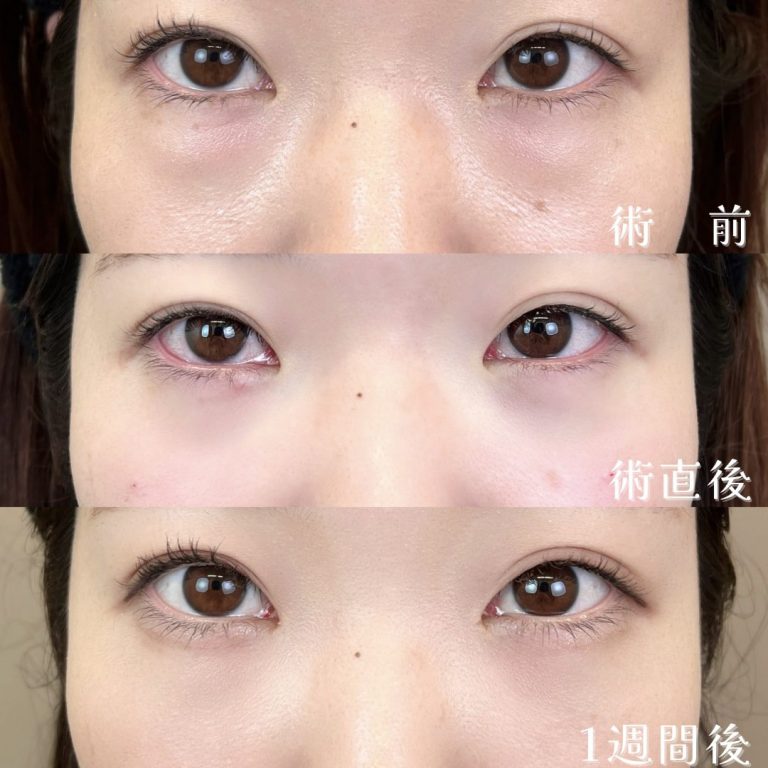 切らない目の下のクマ取り・目の下のたるみ（ふくらみ）取り(担当医:TCB 医師)の症例写真2