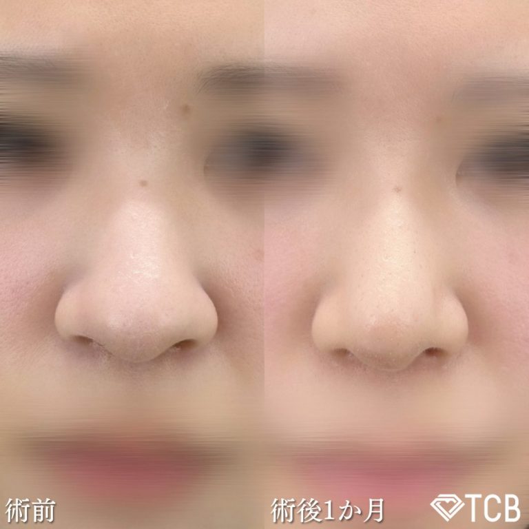 鼻尖形成(担当医:奥田 真吾 医師)の症例写真1