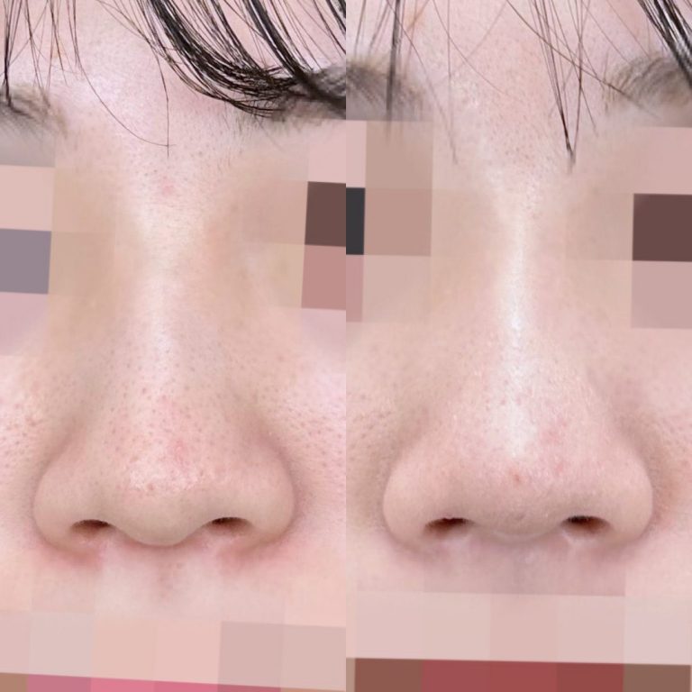 鼻尖形成(担当医:大隈 宏通 医師)の症例写真1