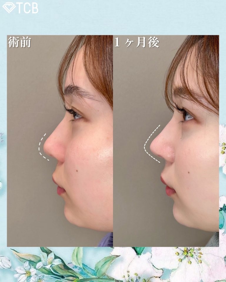 鼻尖形成(担当医:渡邉 正士 医師)の症例写真2