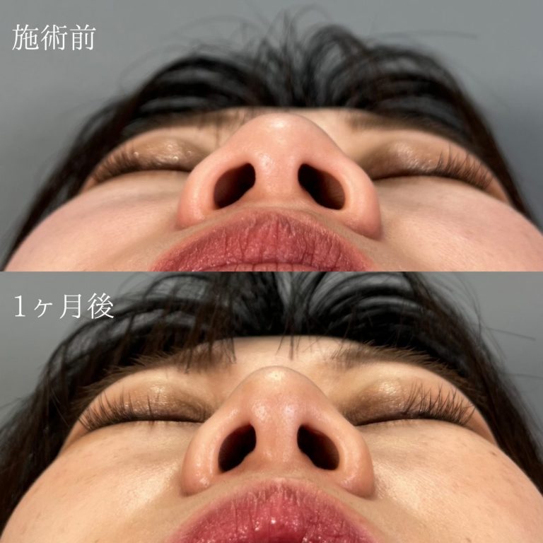 鼻尖形成(担当医:圓田 倫永 医師)の症例写真2