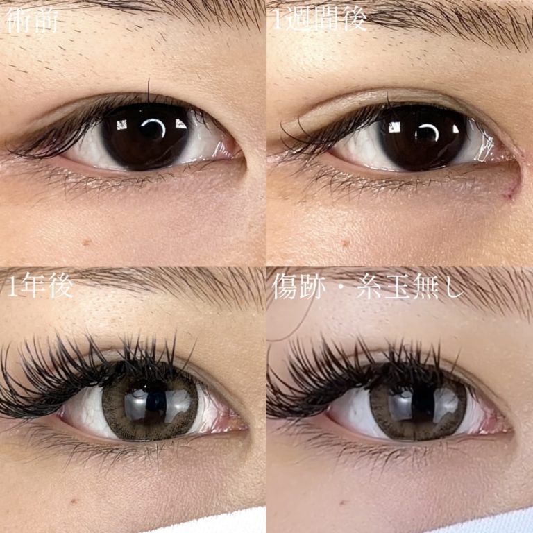 二重埋没法(担当医:TCB 医師)の症例写真1