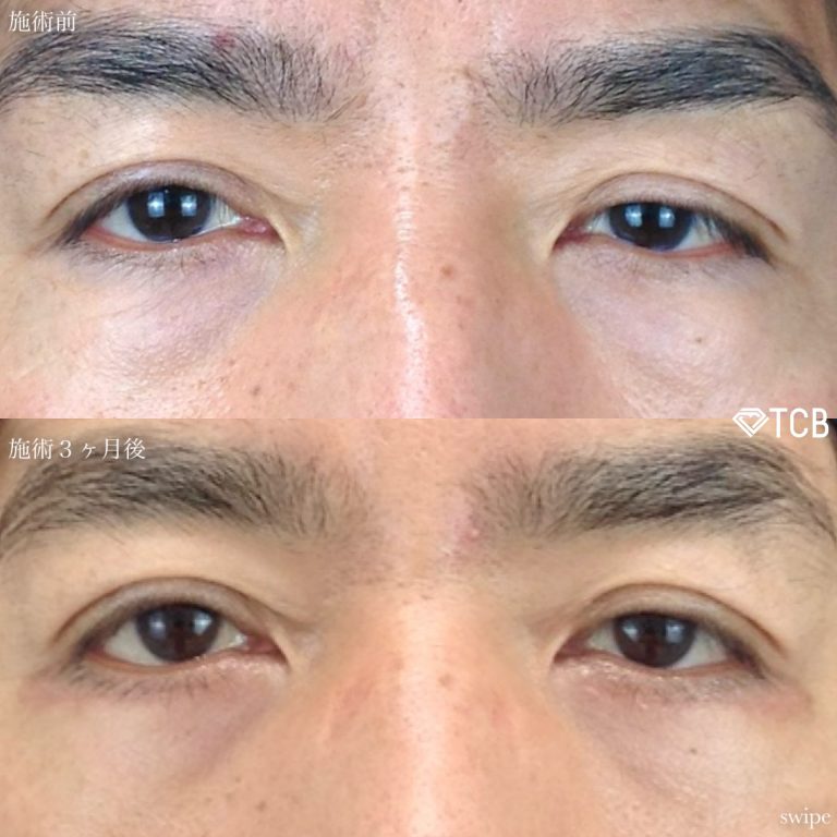 切開法による目の下のたるみ取り（下眼瞼除皺術）(担当医:寺西 宏王 医師)の症例写真1