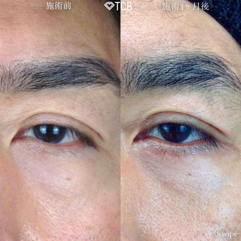 切開法による目の下のたるみ取り（下眼瞼除皺術）(担当医:寺西 宏王 医師)の症例写真2