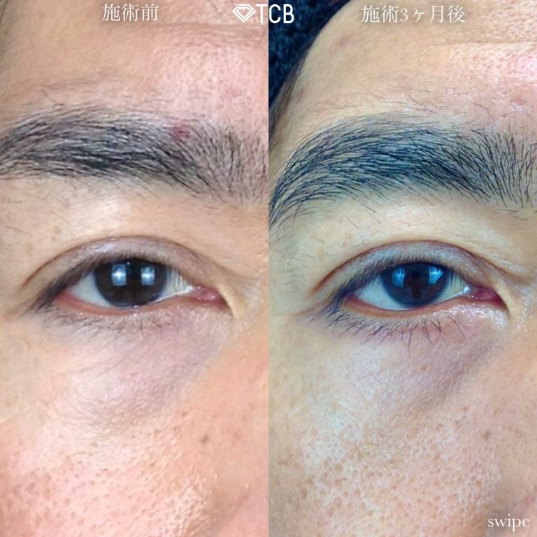 切開法による目の下のたるみ取り（下眼瞼除皺術）(担当医:寺西 宏王 医師)の症例写真3