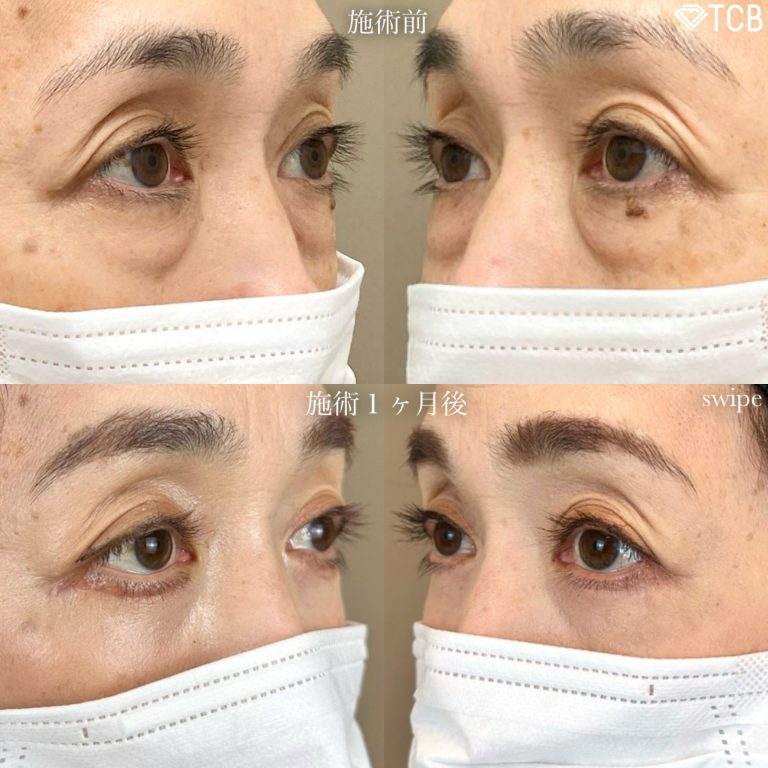 眼瞼下垂手術（切開法）(担当医:寺西 宏王 医師)の症例写真1