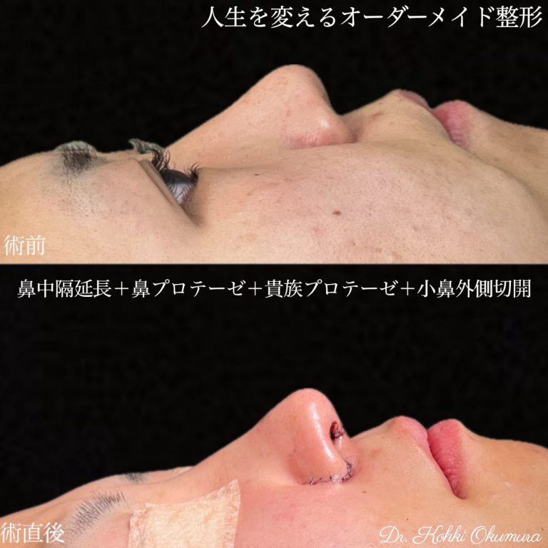 鼻中隔延長術(担当医:奥村 公貴 医師)の症例写真1