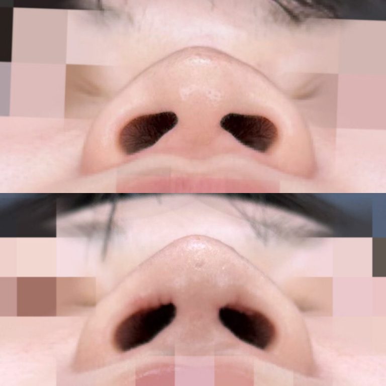 鼻尖形成(担当医:大隈 宏通 医師)の症例写真3