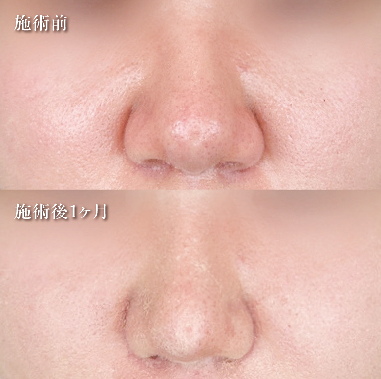TCB式鼻先尖鋭術（だんご鼻解消）(担当医:TCB 医師)の症例写真4