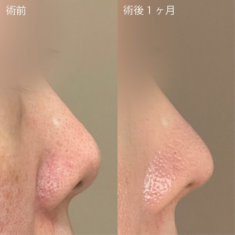 鼻尖形成(担当医:鈴木 大路 医師)の症例写真2
