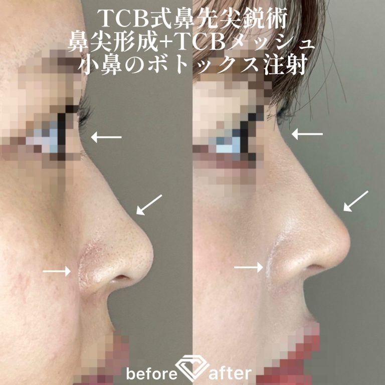 TCB式鼻先尖鋭術（だんご鼻解消）(担当医:森本 理一郎 医師)の症例写真3