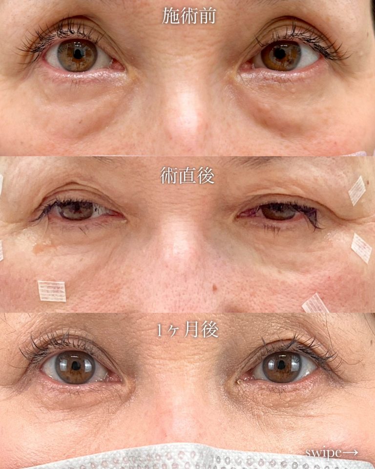 お顔の脂肪注入「ナノファット2.0」(担当医:寺西 宏王 医師)の症例写真4