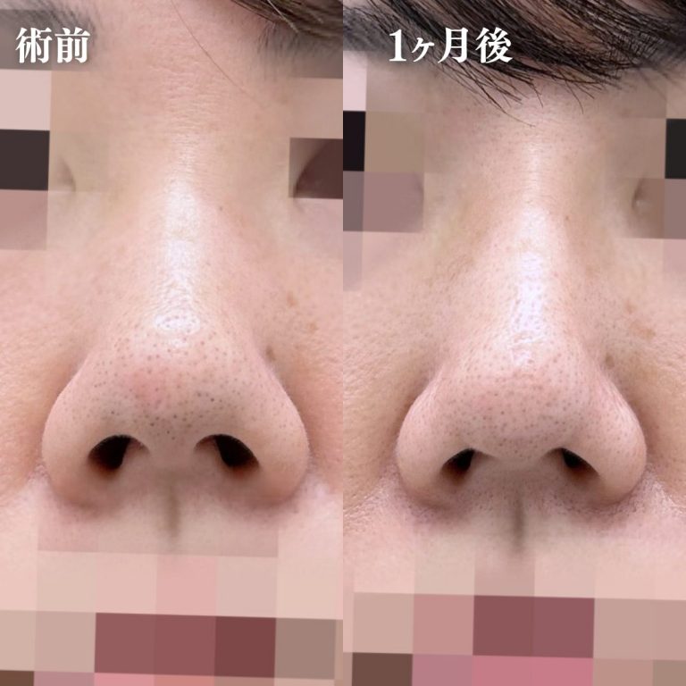 鼻筋・鼻を高くする施術（隆鼻術・ワシ鼻修正・TCBメッシュ）(担当医:大隈 宏通 医師)の症例写真1