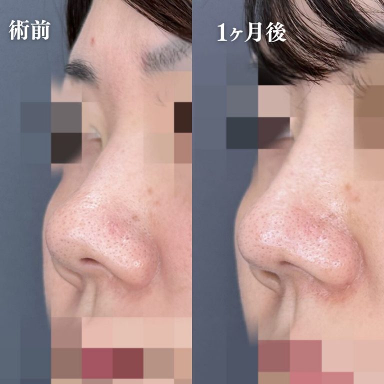 鼻筋・鼻を高くする施術（隆鼻術・ワシ鼻修正・TCBメッシュ）(担当医:大隈 宏通 医師)の症例写真2