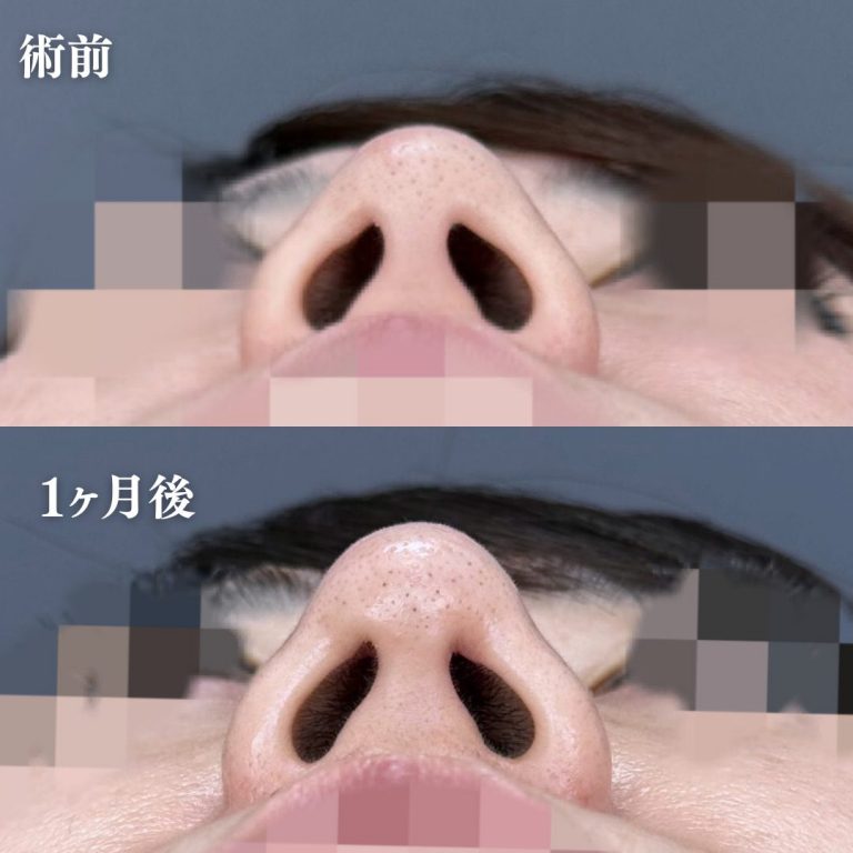 鼻筋・鼻を高くする施術（隆鼻術・ワシ鼻修正・TCBメッシュ）(担当医:大隈 宏通 医師)の症例写真3