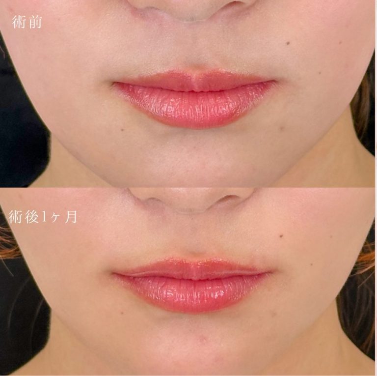 唇のヒアルロン酸注射(担当医:岡本 卓也 医師)の症例写真1