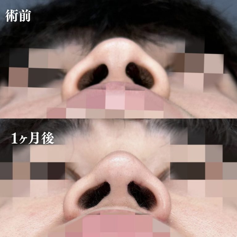 切らない小鼻縮小（鼻翼縮小埋没法）(担当医:大隈 宏通 医師)の症例写真3