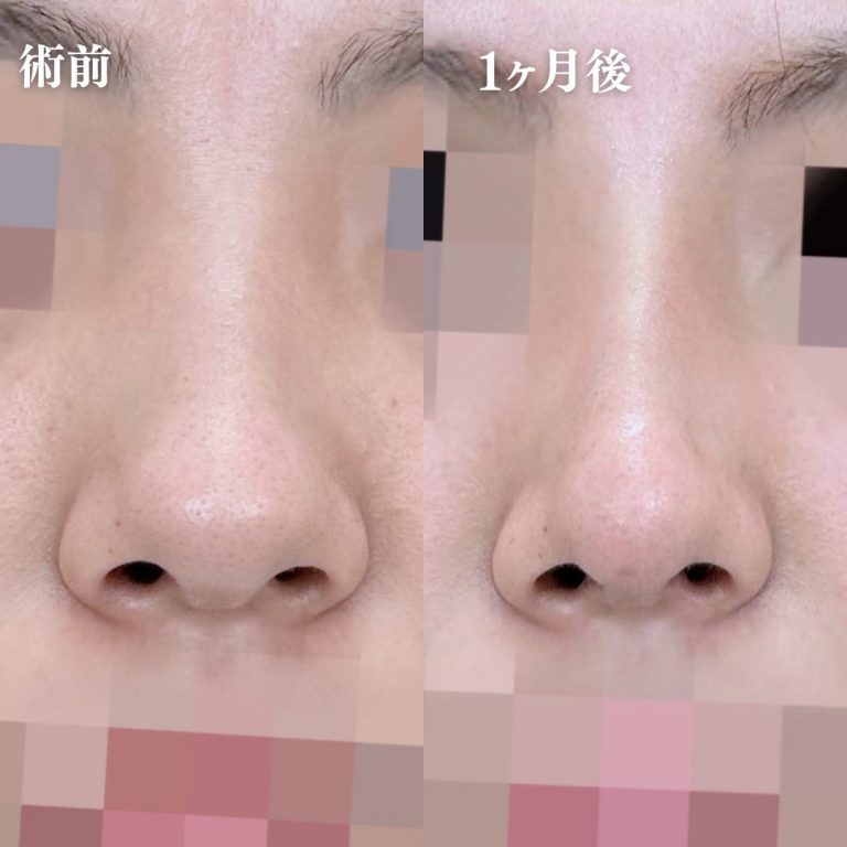 TCB式鼻先尖鋭術（だんご鼻解消）(担当医:大隈 宏通 医師)の症例写真1