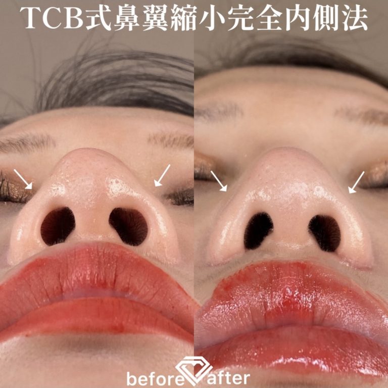 TCB式鼻翼縮小完全内側法(担当医:森本 理一郎 医師)の症例写真4