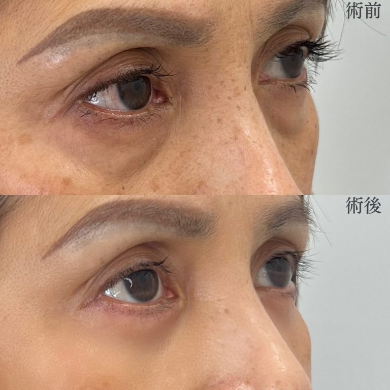 切開法による目の下のたるみ取り（下眼瞼除皺術）(担当医:栗林 理佳 医師)の症例写真1