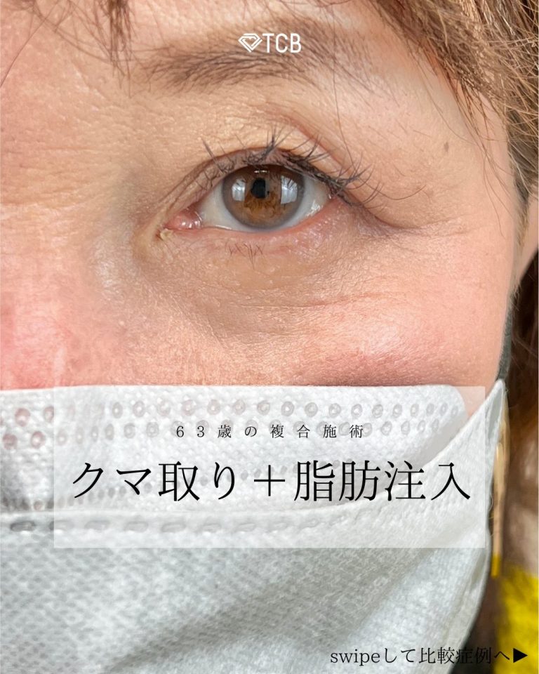お顔の脂肪注入「ナノファット2.0」(担当医:寺西 宏王 医師)の症例写真1