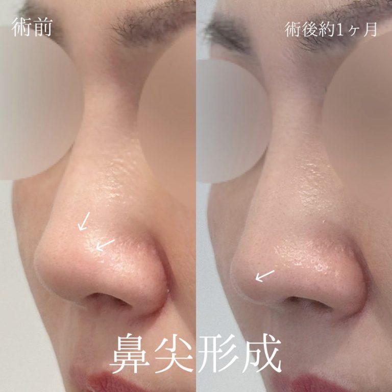 鼻尖形成(担当医:中山 悠希 医師)の症例写真1
