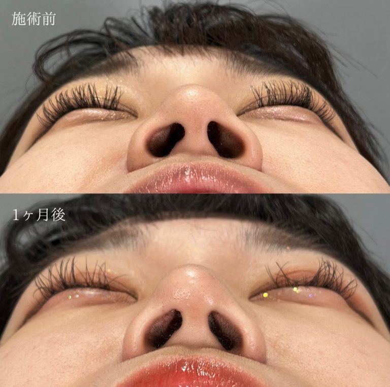 TCB式鼻翼縮小完全内側法(担当医:圓田 倫永 医師)の症例写真2