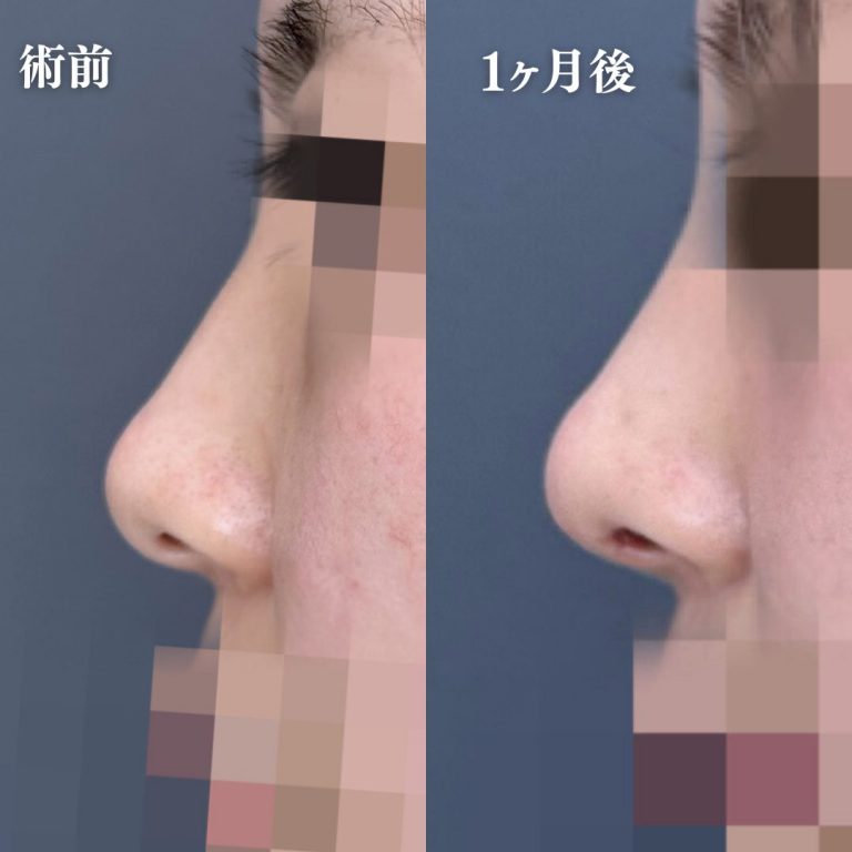 TCB式鼻先尖鋭術（だんご鼻解消）(担当医:大隈 宏通 医師)の症例写真3